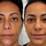 Transformação estética em foco: Samantha Schmütz recorre a médico renomado e renova visual com procedimentos de destaque