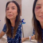 Ivete Sangalo Revela Cirurgia no Rosto e Detalha Recuperação Após Queda com Lesão Grave
